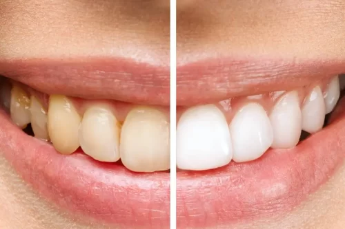 Teeth Whitening Cost: In-Office vs At-Home Options (2026 Guide)