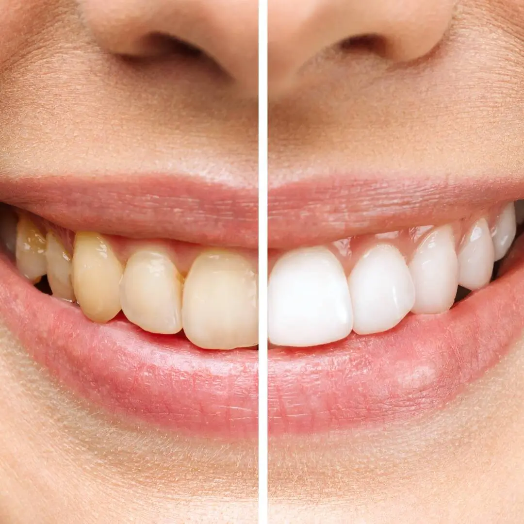 Teeth Whitening Cost: In-Office vs At-Home Options (2026 Guide)