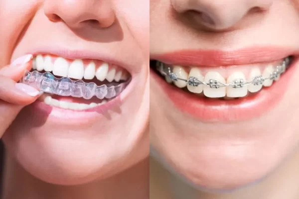 invisalign vs. braces